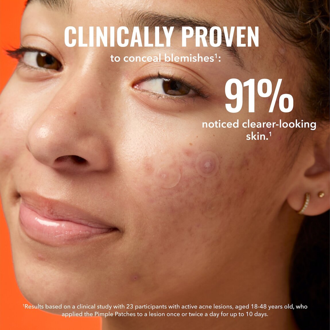 pimple-patches-r1 zb_p.jpg