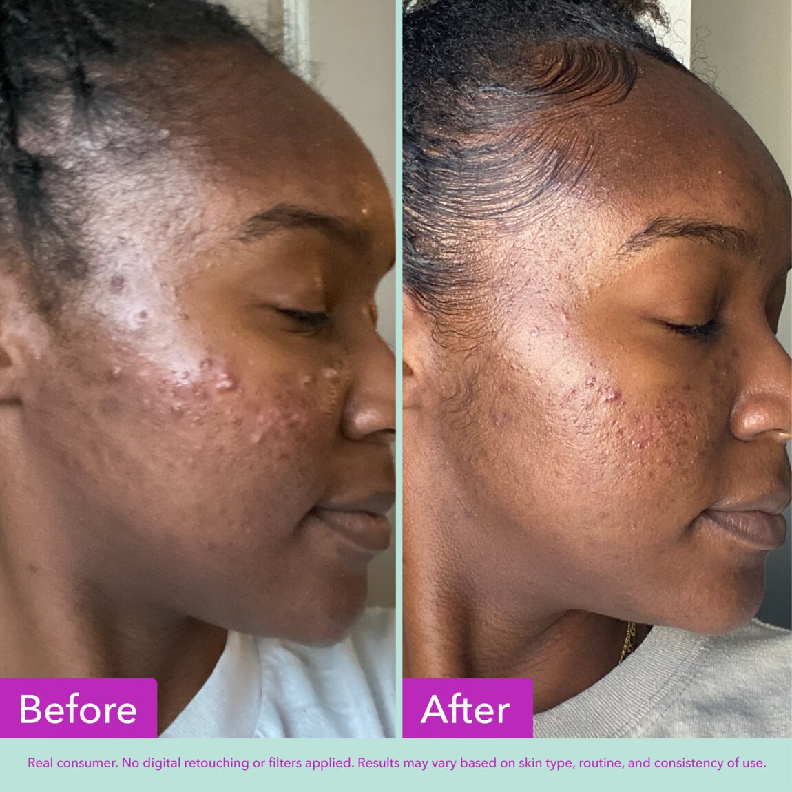 acne-foaming-cleanser-c5 zb_p.jpg